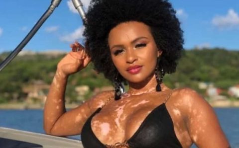 Vitiligo: pessoas com a doença dizem que presença de Natália no BBB ajudou a debater preconceito