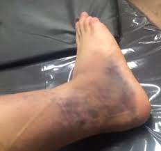Em recuperação no CT do Santos, Alex Nascimento mostra situação de tornozelo