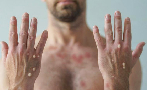 MT:  EMERGÊNCIA SANITÁRIA:   Pesquisadores cobram medidas para enfrentamento da varíola dos macacos