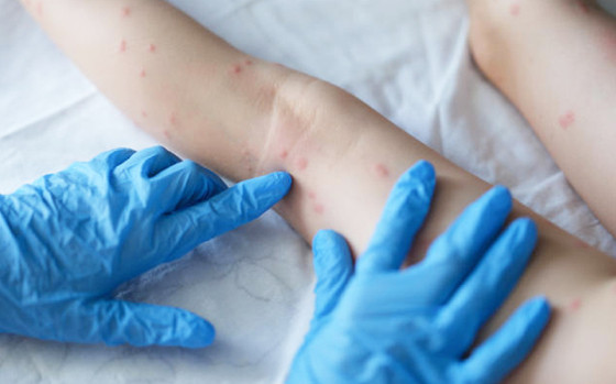 MT:  MONKEYPOX VÍRUS:   Saúde já notificou 225 casos de varíola dos macacos em Mato Grosso
