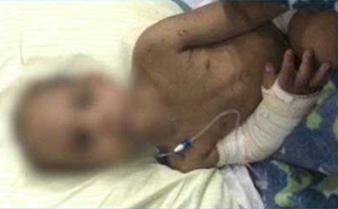 SUSPEITOS FUGIRAM: Criança de quatro anos tem costelas fraturadas pelo padrasto e mãe por fazer “bagunça”