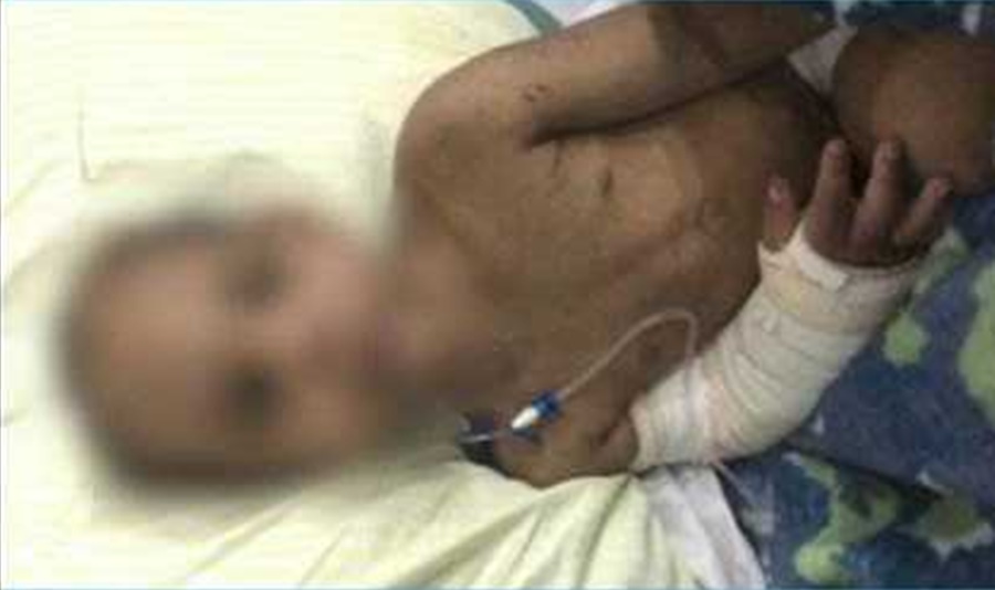 SUSPEITOS FUGIRAM: Criança de quatro anos tem costelas fraturadas pelo padrasto e mãe por fazer “bagunça”