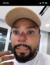 Mancha no nariz de Naldo Benny após procedimento estético preocupa fãs e cantor explica.