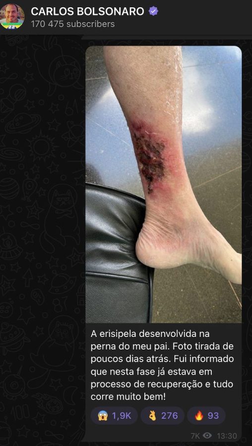 Carlos posta foto de perna de Bolsonaro com erisipela; veja