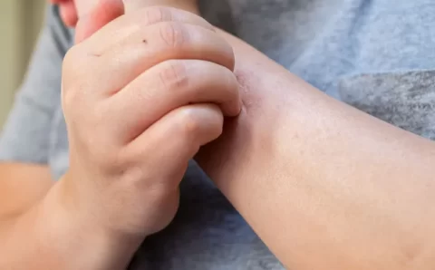 Entenda o que é Herpes Zoster e quais os principais sintomas da doença