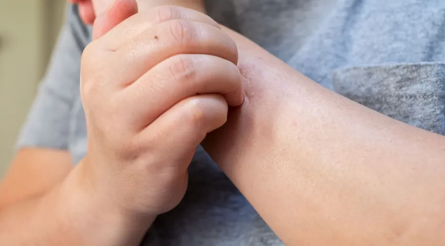 Entenda o que é Herpes Zoster e quais os principais sintomas da doença