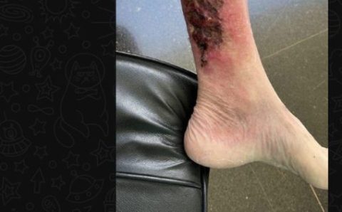 O que é erisipela, problema que afeta a perna de Bolsonaro?