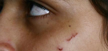 Marido é preso por ferir mulher com caco de vidro após briga