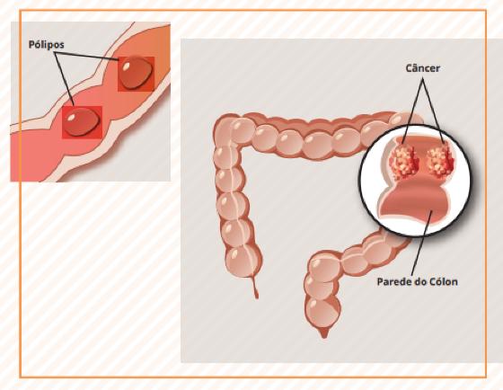 DIAGNOSTICADO EM PRETA GIL:    Câncer de intestino é o 3° com maior incidência; esteja atento a sinais e riscos