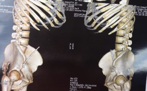 MT:  SAÚDE:  Hospital de MT esquece tesoura em abdômen de paciente durante cirurgia