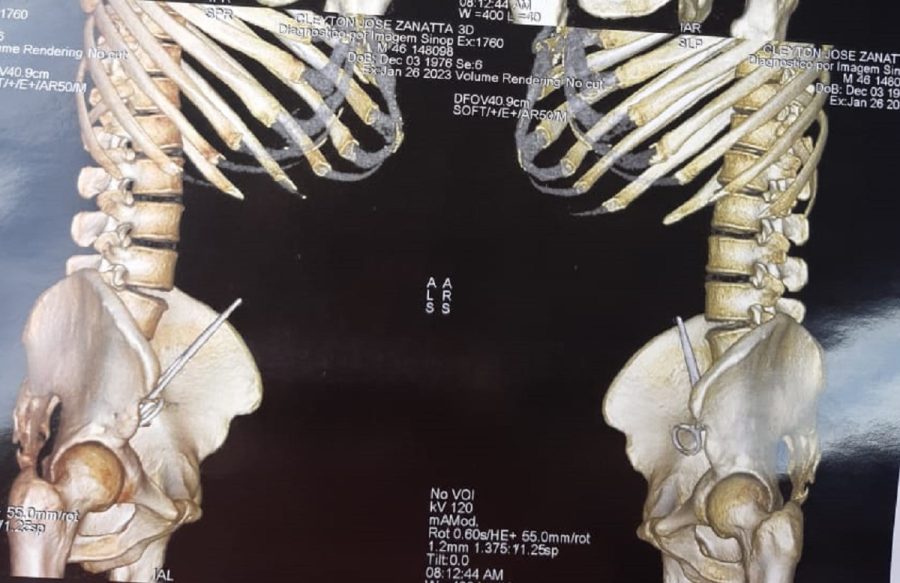 MT:  SAÚDE:  Hospital de MT esquece tesoura em abdômen de paciente durante cirurgia