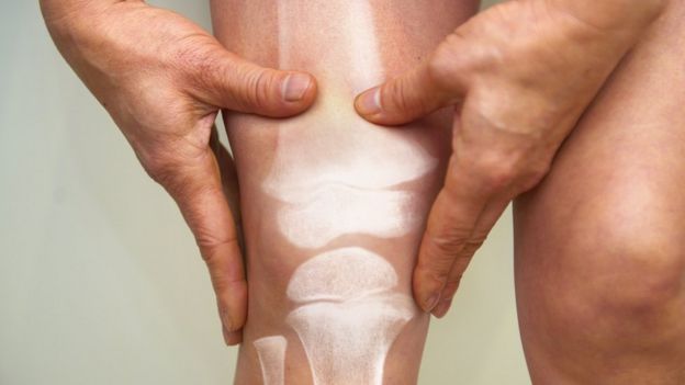 Osteoporose masculina: a doença silenciosa que causa fraturas em milhares de homens todos os anos
