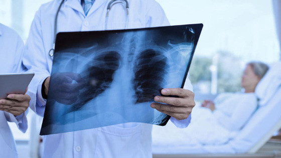MT:  AGOSTO BRANCO:   MT tem alta incidência de pessoas com câncer de pulmão