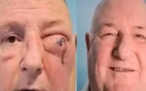 MT:  Homem quase perde a visão aocontrair bactéria após infecção no dente