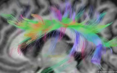 Descoberta a origem da gagueira no cérebro