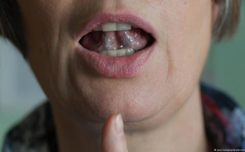 Descoberta a origem da gagueira no cérebro