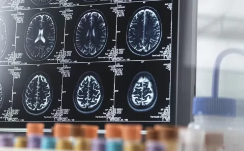 O que faz o cérebro envelhecer mais rápido? Novo estudo indica fatores de risco