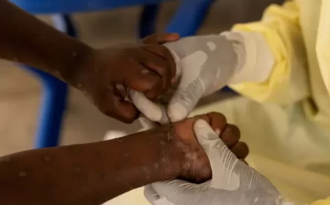Saiba quais os 8 países que registram casos da nova variante de mpox