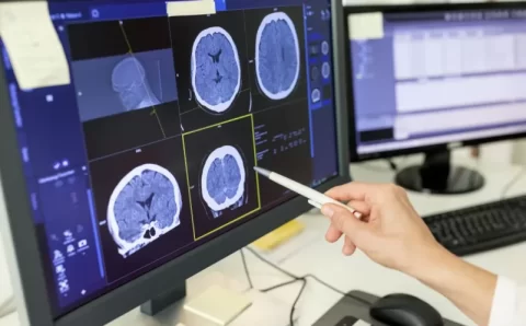 Doenças neurodegenerativas: o que são, sinais de alerta e como diagnosticar