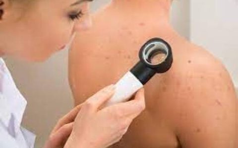 MT:  DEZEMBRO LARANJA:   Saúde orienta sobre a prevenção e detecção do câncer de pele