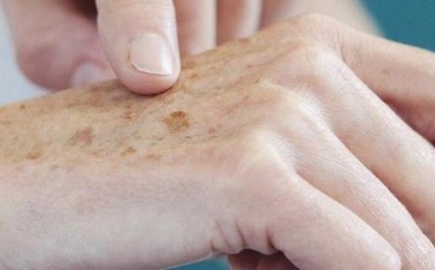 SES orienta a população sobre a prevenção e detecção precoce do câncer de pele