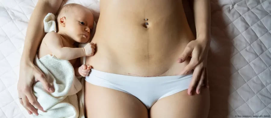 Turquia restringe cesáreas para aumentar taxa de natalidade