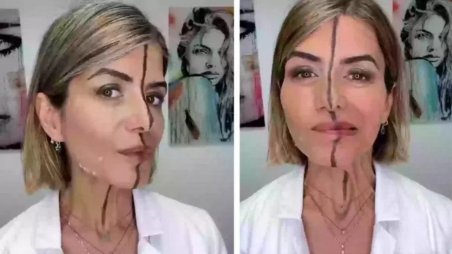 Médica aplica botox em apenas um lado do rosto para mostrar efeitos; veja