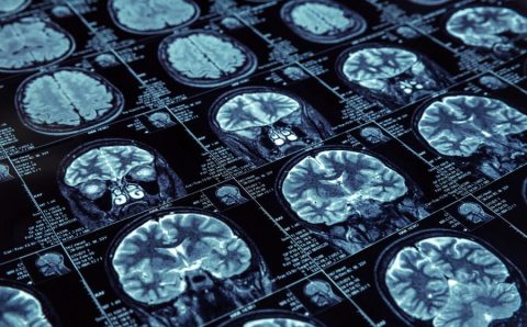 O que se sabe sobre as bases bioquímicas da doença de Alzheimer?