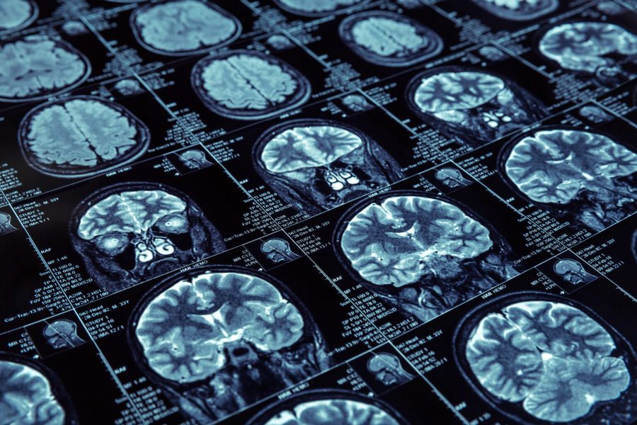 O que se sabe sobre as bases bioquímicas da doença de Alzheimer?