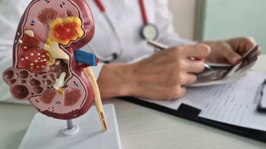 Câncer renal deve crescer quase 80% no Brasil e na América Latina até 2050