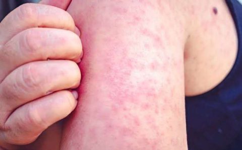 Várzea Grande reforça vacinação após novo caso suspeito de sarampo