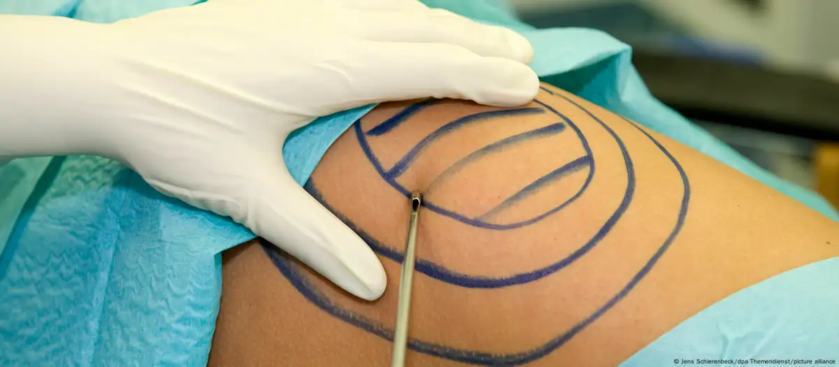 Lipoaspiração: a cirurgia plástica mais realizada no Brasil