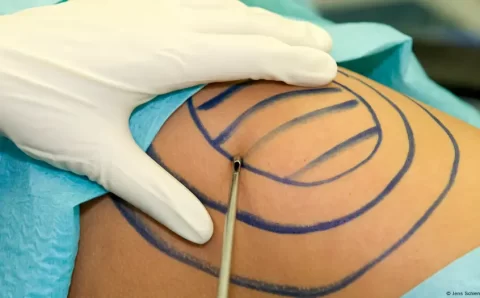 Lipoaspiração: a cirurgia plástica mais realizada no Brasil