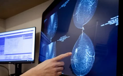 IA prevê risco de câncer de mama com 5 anos de antecedência