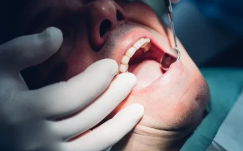 Cáries e doença da gengiva aumentam risco de AVC, diz estudo