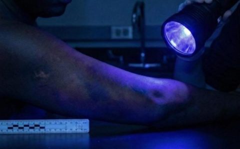Estudo avalia a eficiência do uso de luzes forenses na detecção de hematomas em pessoas negras
