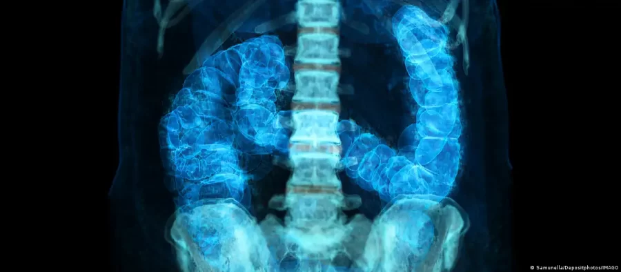 Câncer colorretal cresce entre jovens; veja fatores de risco