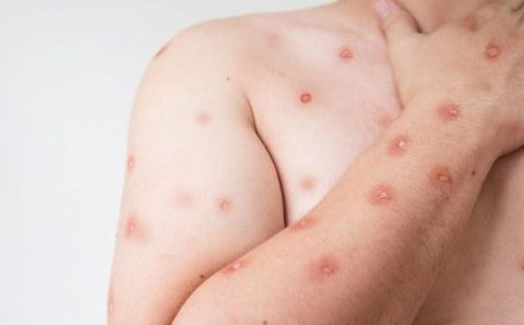 SES alerta para monitoramento de casos de Mpox em MT após avanço de variante em Rondônia