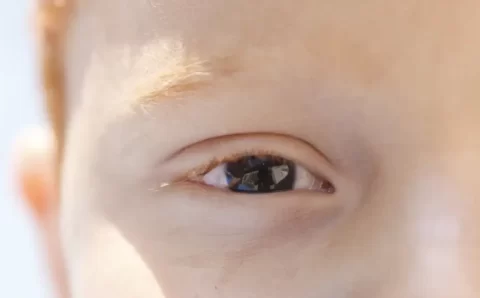 Fotoceratite exige cuidados redobrados no verão