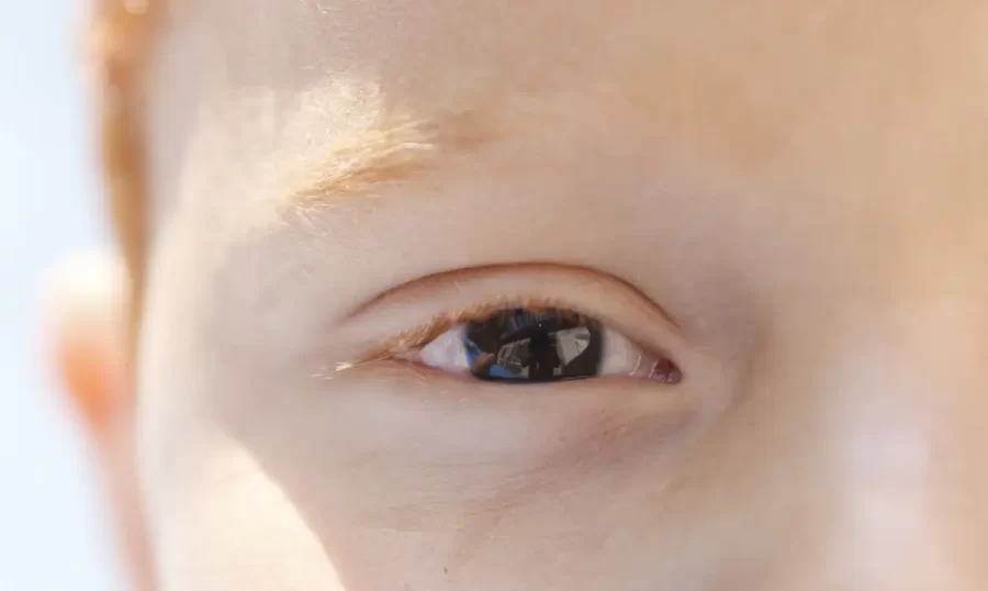 Fotoceratite exige cuidados redobrados no verão