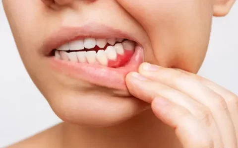 Feridas persistentes e manchas vermelhas podem indicar câncer de boca