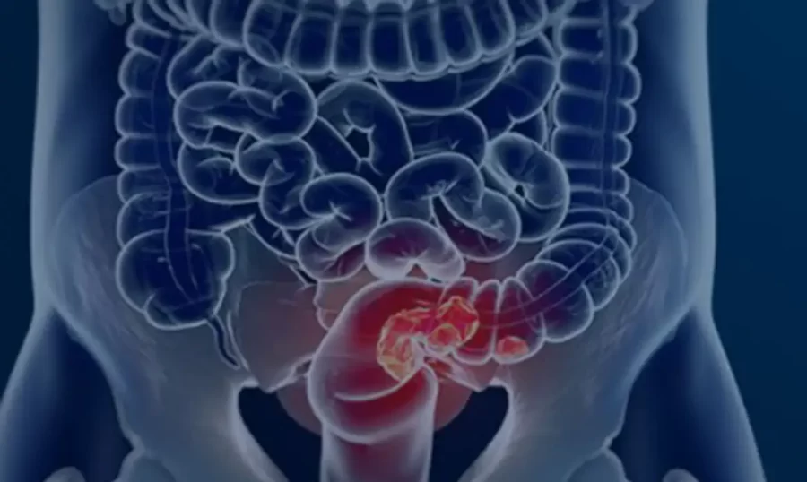 Rastreamento para câncer colorretal pode ser implementado no SUS