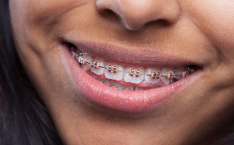 Por que o dente entorta após usar aparelho? Veja como evitar o problema