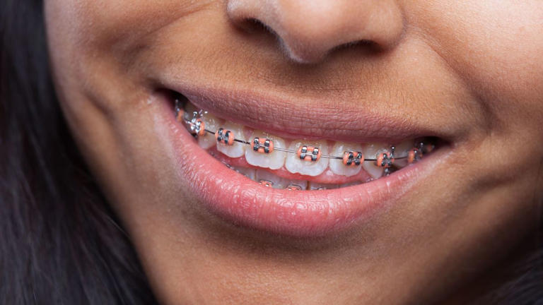 Por que o dente entorta após usar aparelho? Veja como evitar o problema