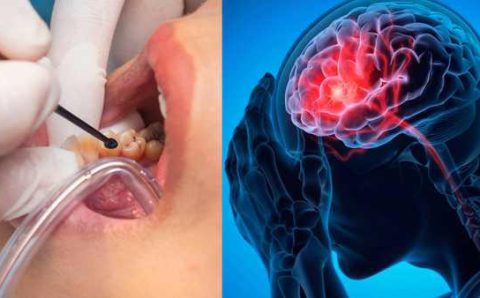 O que cárie e gengivite têm a ver com AVC? Estudo indica aumento significativo no risco de derrame