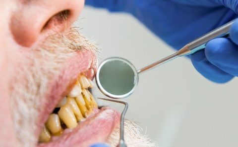SAÚDE BUCAL:   Doença periodontal é uma das principais causas de perda total de dentes; conheça outros tipos de infecções