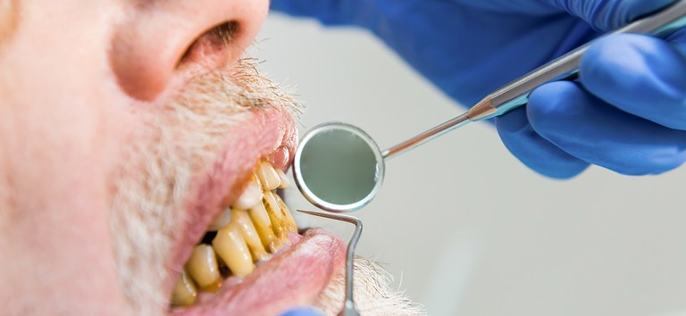 SAÚDE BUCAL:   Doença periodontal é uma das principais causas de perda total de dentes; conheça outros tipos de infecções