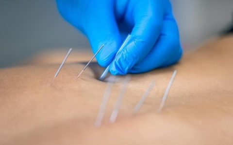 SES promove curso de acupuntura para médicos da Atenção Básica