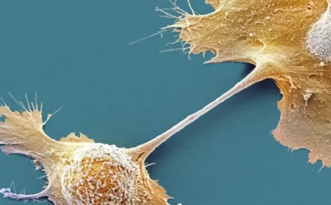Medicamento prolonga vida de pessoas com câncer de pâncreas