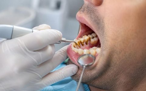 Como tratar o tártaro escuro nos dentes e diminuir o risco de perder nutrientes a curto prazo